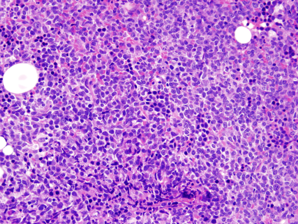 BM biopsy_200x